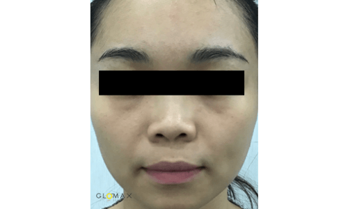 Glomax Aesthetics - WishPro MIT Repairing Treatment