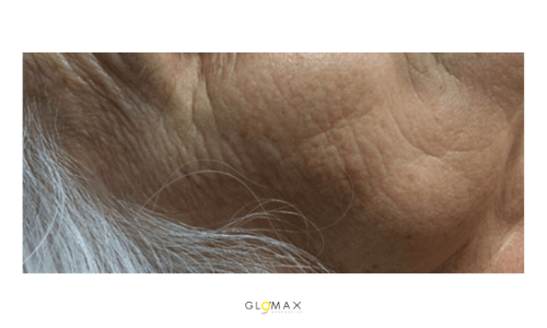 Glomax Aesthetics - WishPro MIT Repairing Treatment