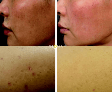 Glomax Aesthetics - BBL Pigmentation Lesions Before  & Treatment