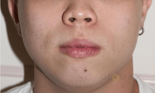 Glomax Aesthetics - BBL Acne After Treatment