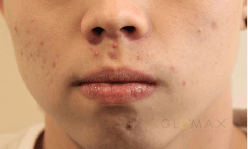 Glomax Aesthetics - BBL Acne Before Treatment