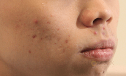 Glomax Aesthetics - BBL Acne Before Treatment