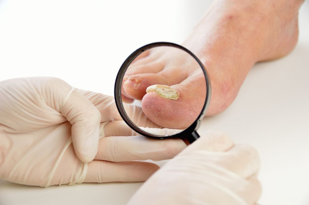 Person's foot being examined with a magnifying glass; infected toenail visible. White gloved hands.