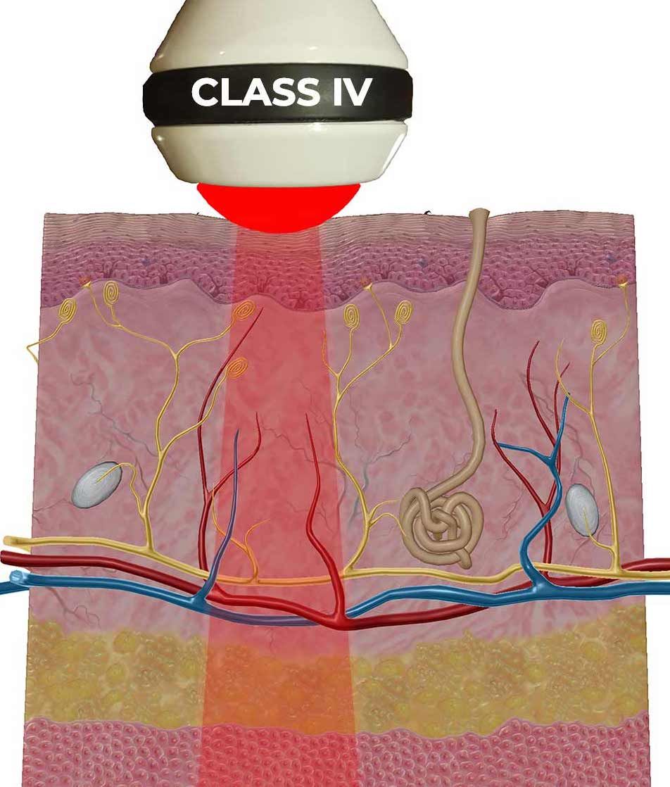 Class 4 Laser therapy burlington