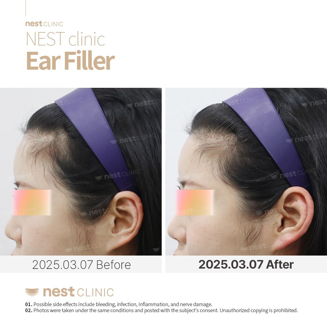 Ear filler before and after at NEST Clinic Gangnam