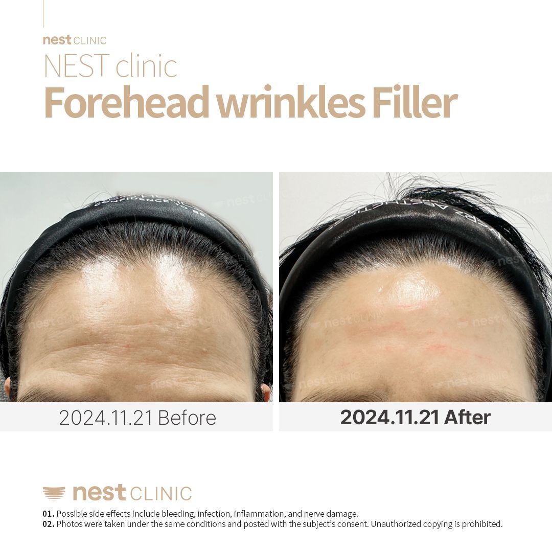 Forehead filler before and after at NEST Clinic Gangnam