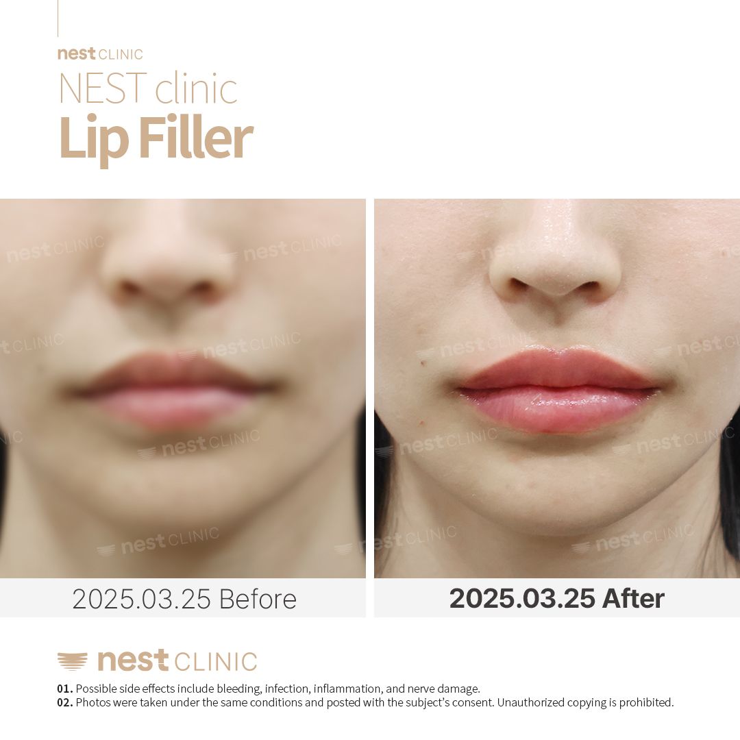 Lip filler before and after at NEST Clinic Gangnam
