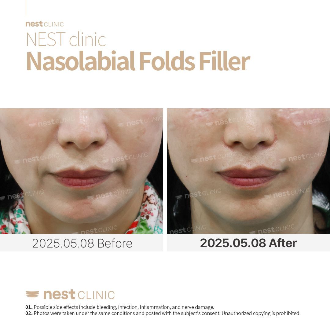 Nasolabial fold filler before and after at NEST Clinic Gangnam
