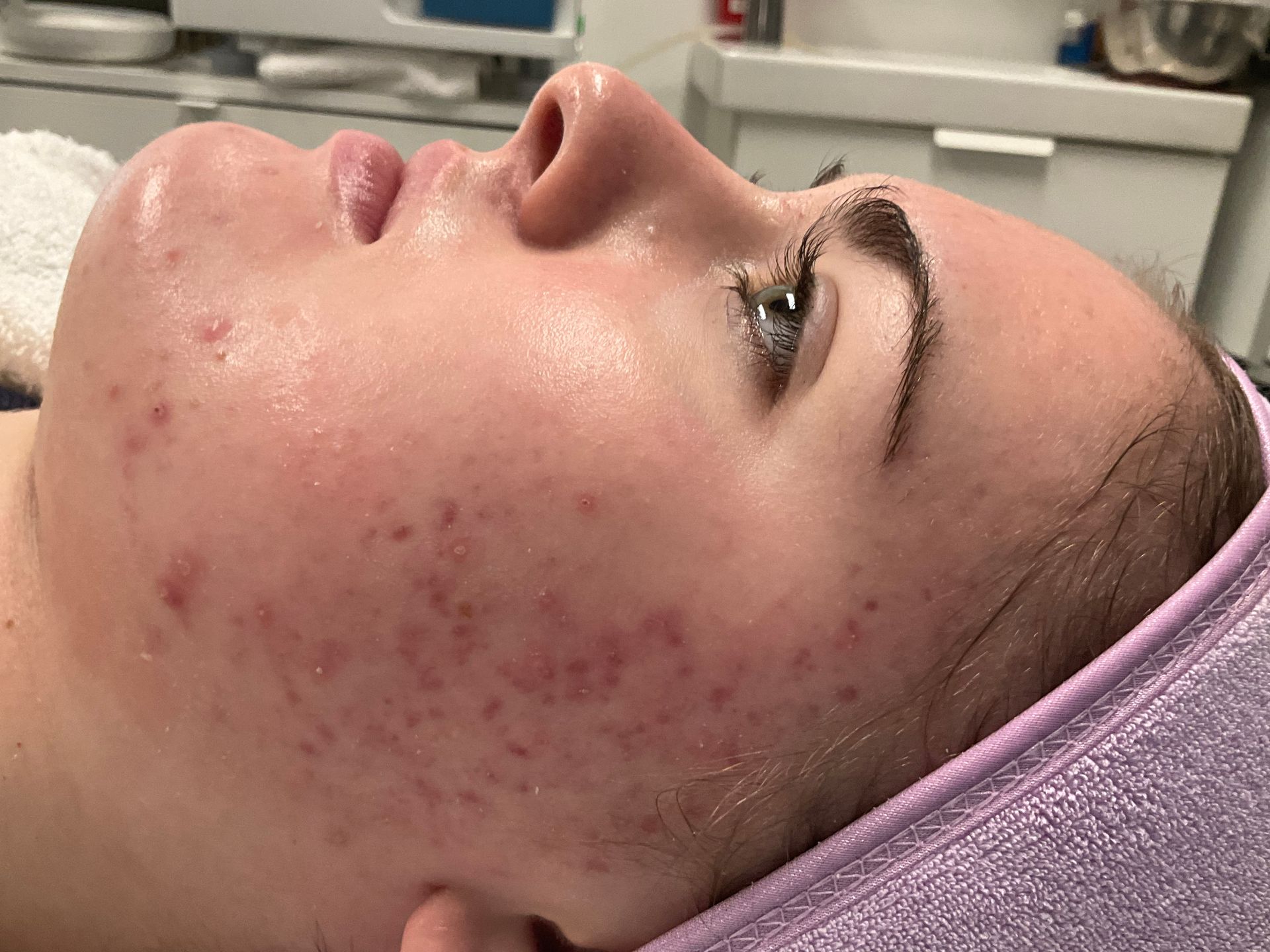 Woman with acne receiving facial treatment, lying on a table with a purple towel; clinic setting.
