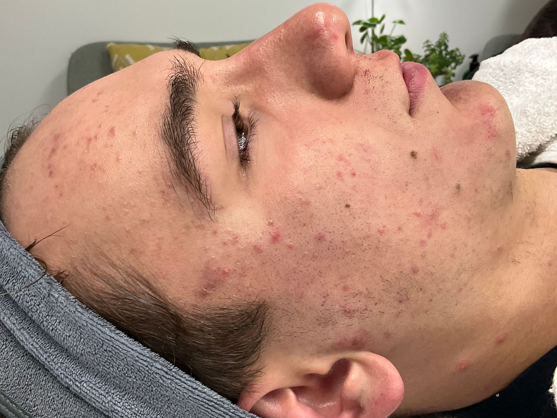 Man with acne on his face, lying down on a towel, at a spa or clinic.