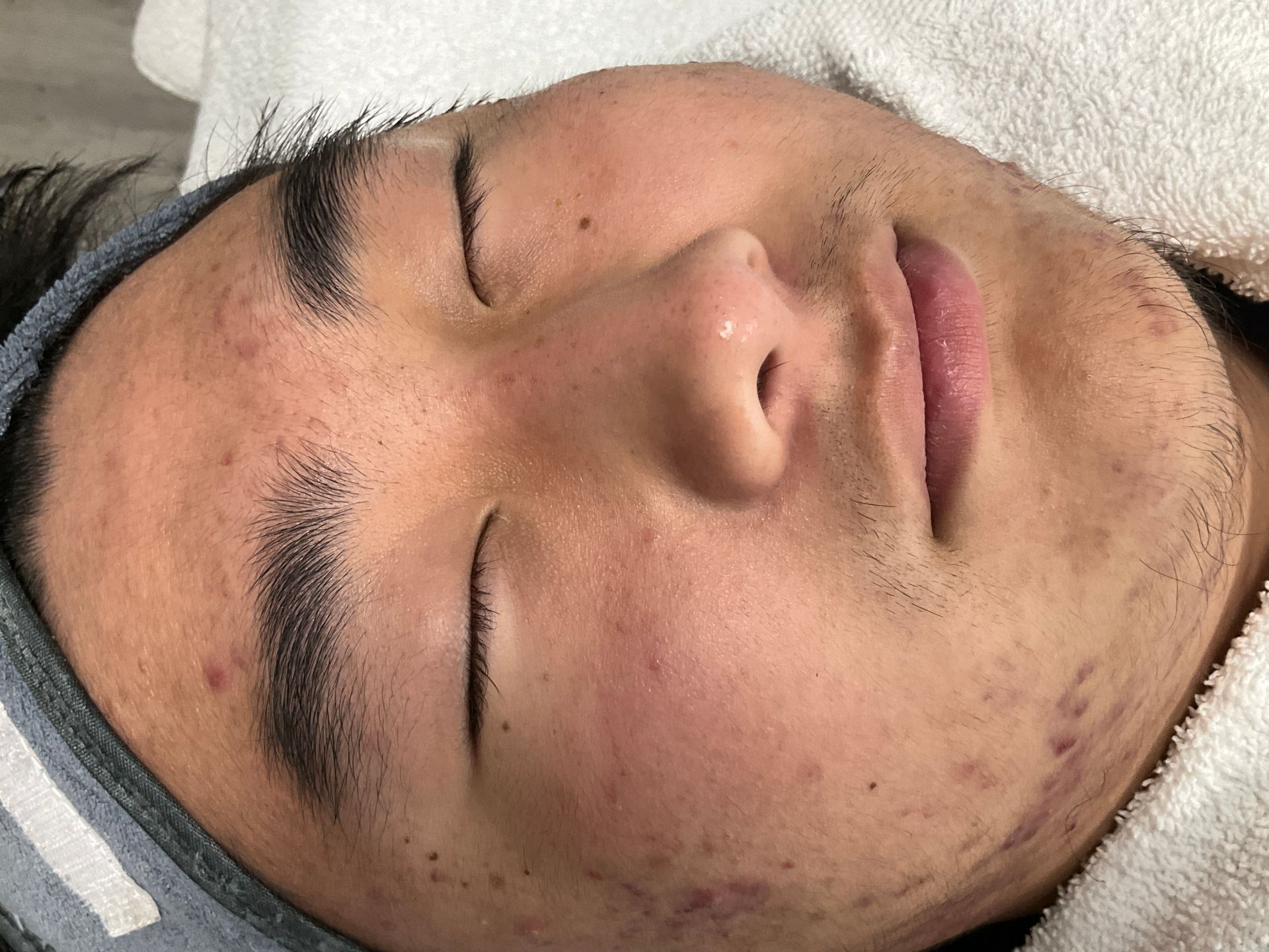 Close-up of a person's face with closed eyes, acne, and stubble, resting on a towel.