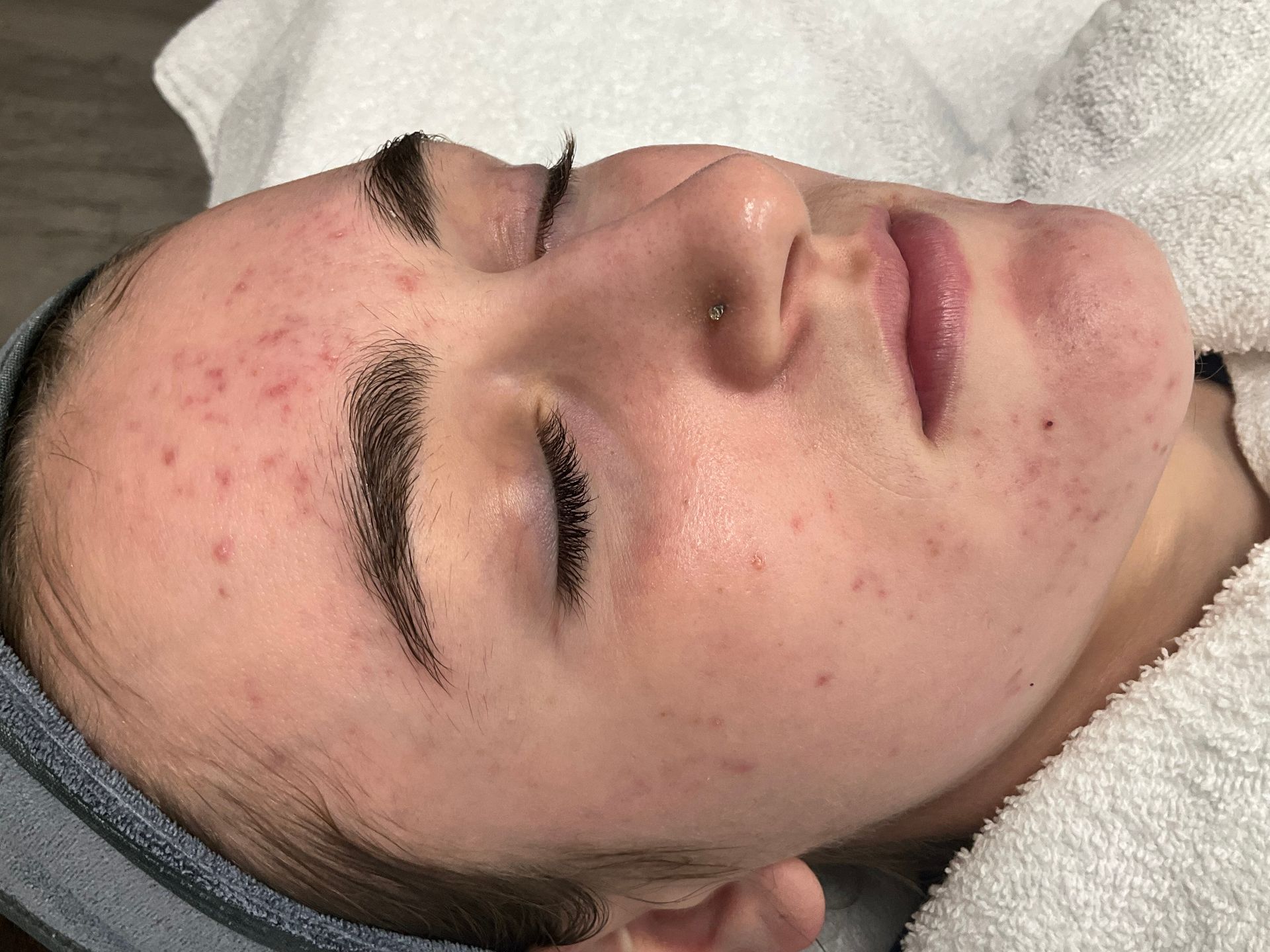 Woman with closed eyes, acne on face, laying on towel.