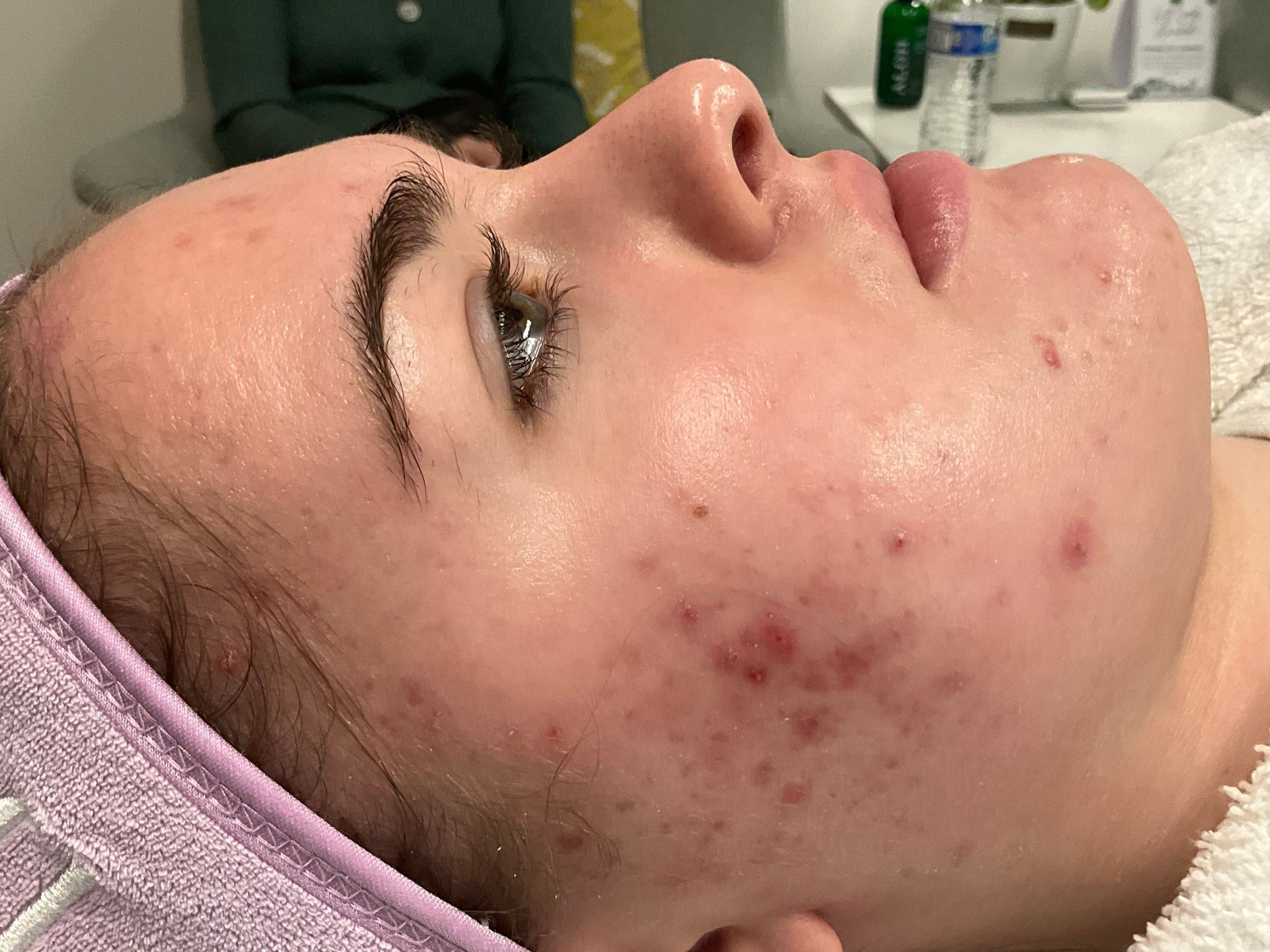 Woman with acne on her cheek, lying down. She has fair skin and is in a spa setting.