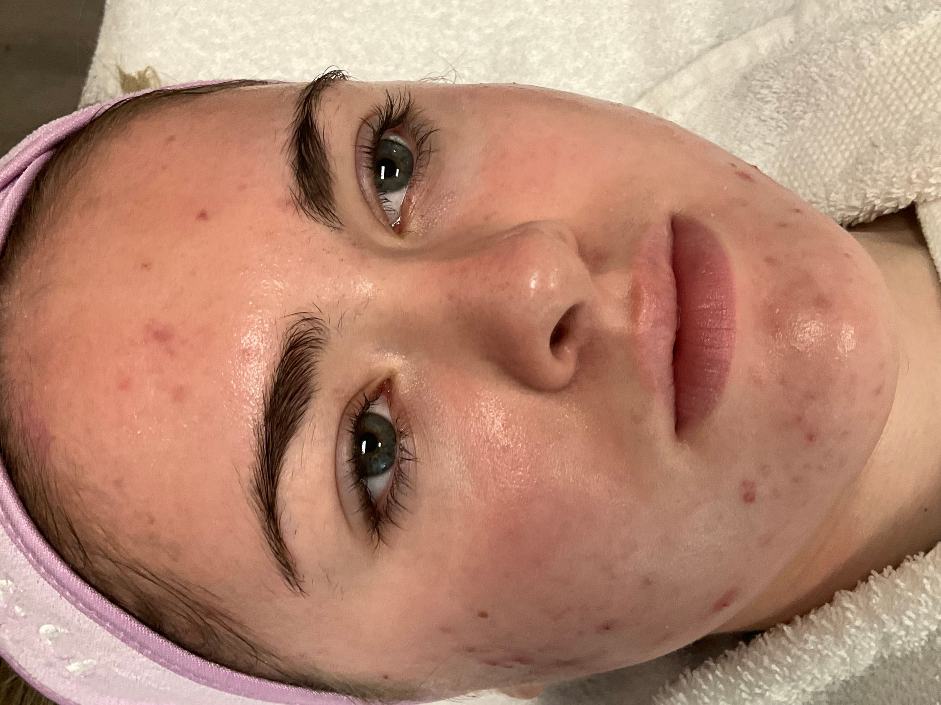 A young woman with acne on her face looks up, wearing a spa headband, resting on white towel.
