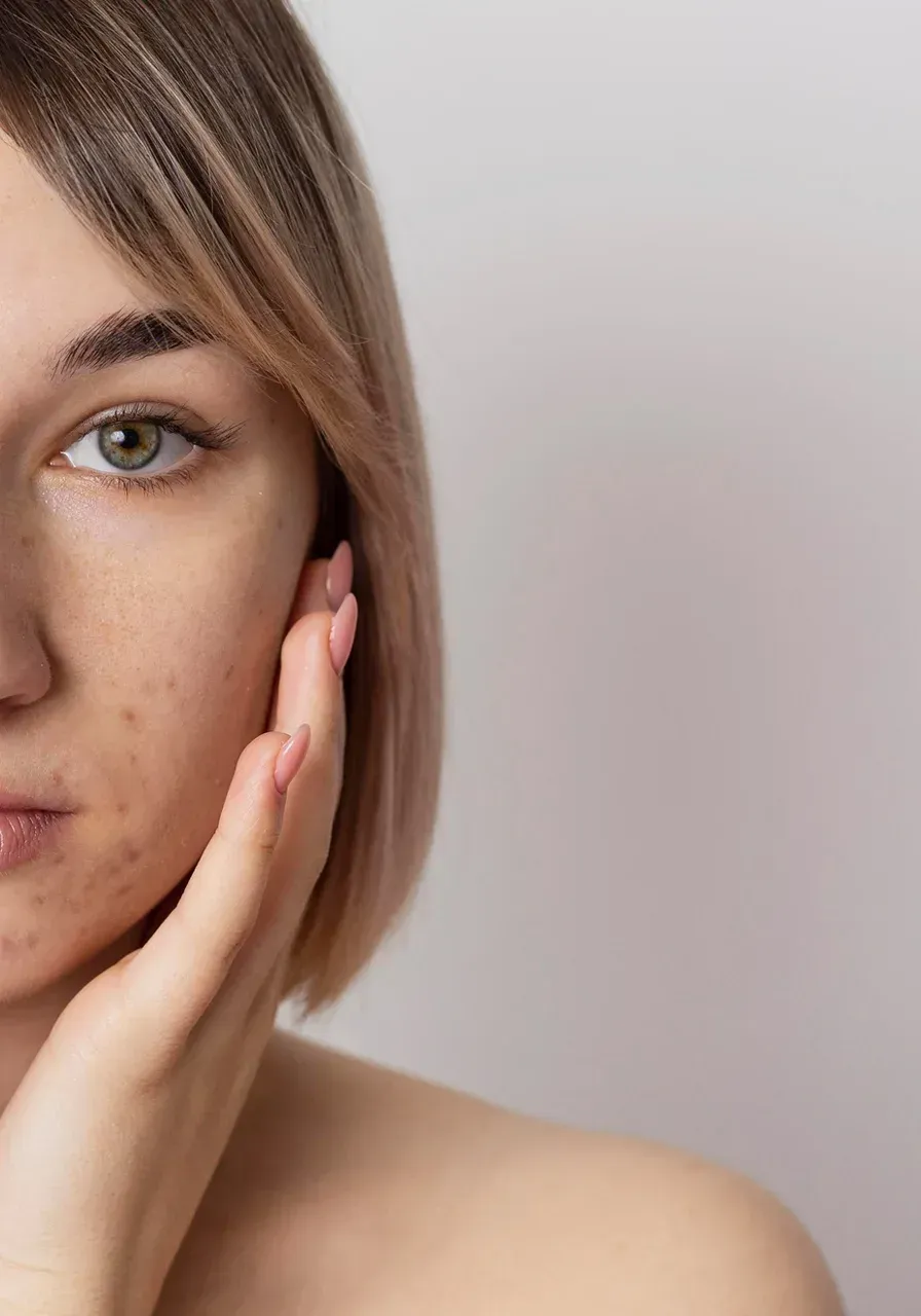 Acne Treatment