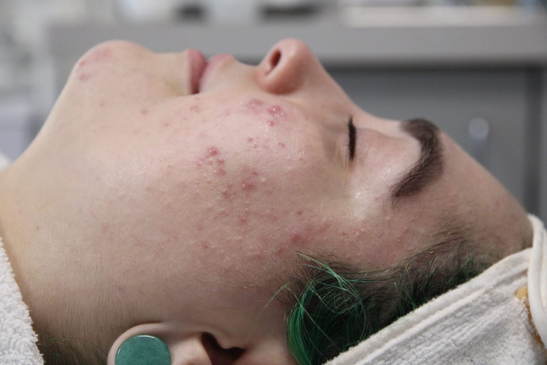 Person with acne on cheek, eyes closed, lying down with towel.