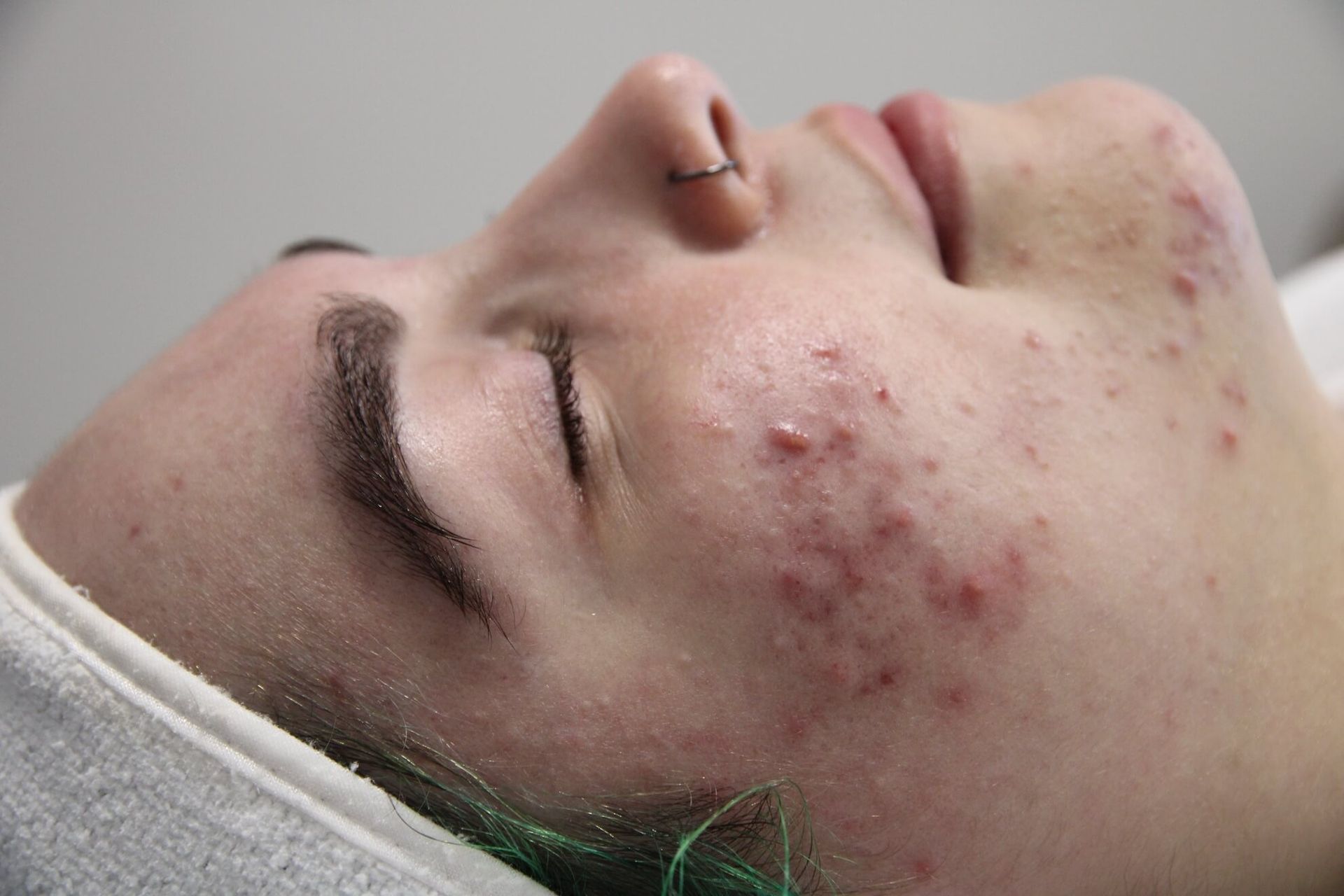 Person with acne on their cheek, lying down with eyes closed.