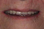 After Dentures — Hamilton, NJ — Joseph Randazzo DDS
