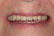 Before Dentures — Hamilton, NJ — Joseph Randazzo DDS