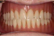 Case 2 Before Dentures — Hamilton, NJ — Joseph Randazzo DDS