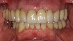 After Comprehensive Full Mouth Rehabilitations — Hamilton, NJ — Joseph Randazzo DDS