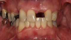 Before Comprehensive Full Mouth Rehabilitations — Hamilton, NJ — Joseph Randazzo DDS