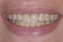 Case 2 After All Ceramic Crown — Hamilton, NJ — Joseph Randazzo DDS