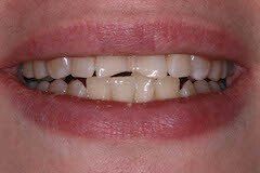 Case 2 Before All Ceramic Crown — Hamilton, NJ — Joseph Randazzo DDS