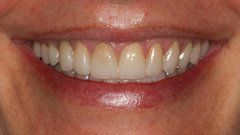 Case 1 After All Ceramic Crown — Hamilton, NJ — Joseph Randazzo DDS