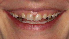Case 1 Before All Ceramic Crown — Hamilton, NJ — Joseph Randazzo DDS