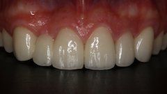 After Porcelain Veneers — Hamilton, NJ — Joseph Randazzo DDS