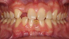 Before Porcelain Veneers — Hamilton, NJ — Joseph Randazzo DDS