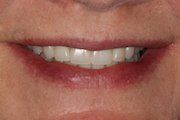 Case 3 After Dental Implant — Hamilton, NJ — Joseph Randazzo DDS