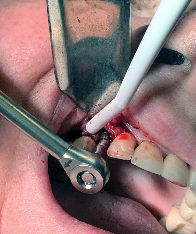 Dental implant removal