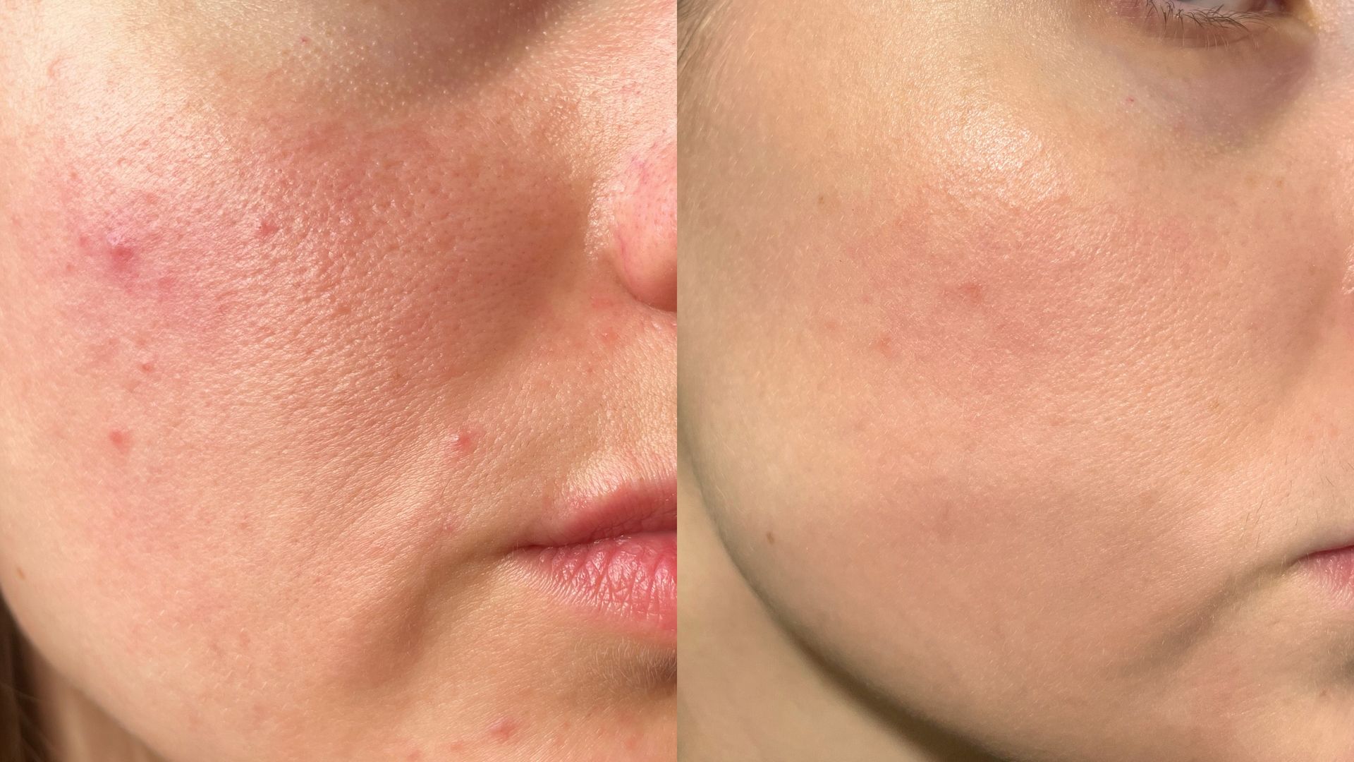 Close-up of two faces with one pressing cheek against the other, both with visible skin redness