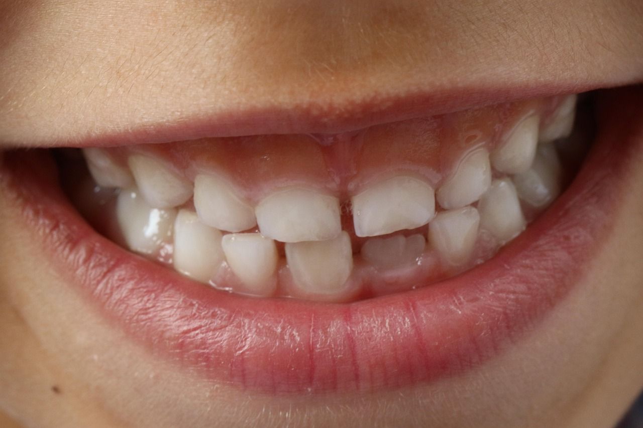 A close up of a child 's teeth with a missing tooth.