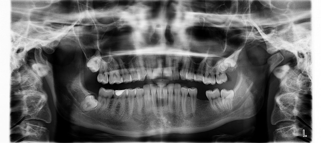 An x-ray of a person 's teeth and skull.