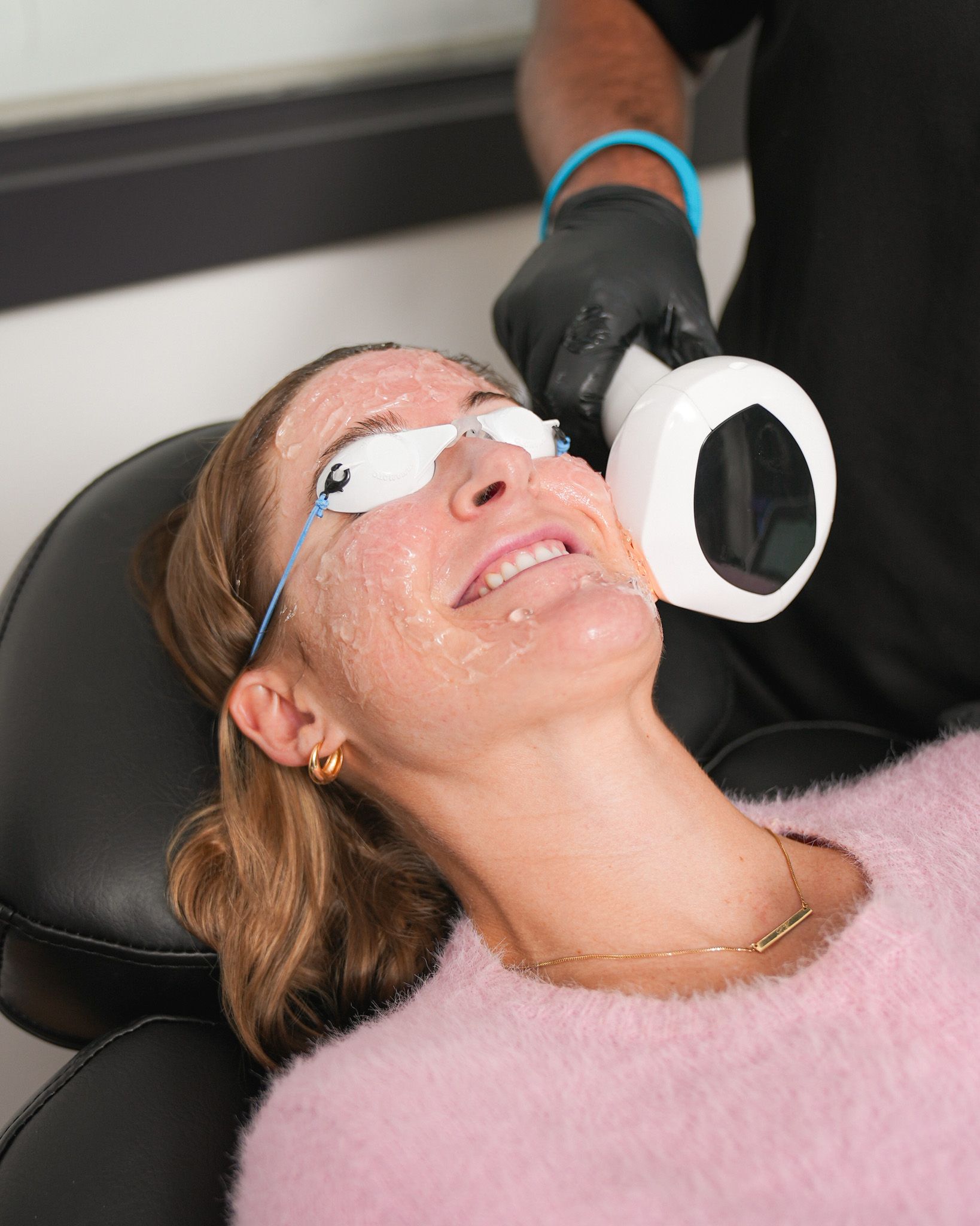 Patient receiving Lumecca IPL treatment at Boston Beautox med spa in South Boston
