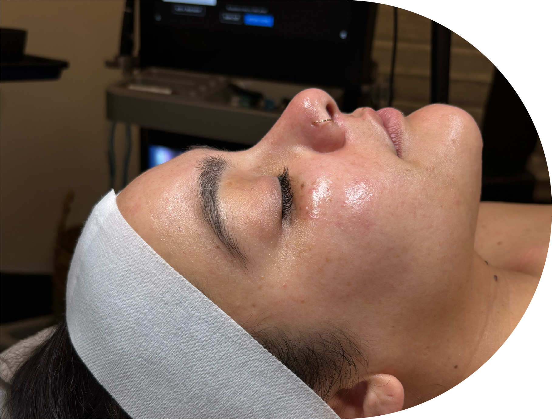 HydraFacial skin treatment being performed at Boston Beautox in South Boston