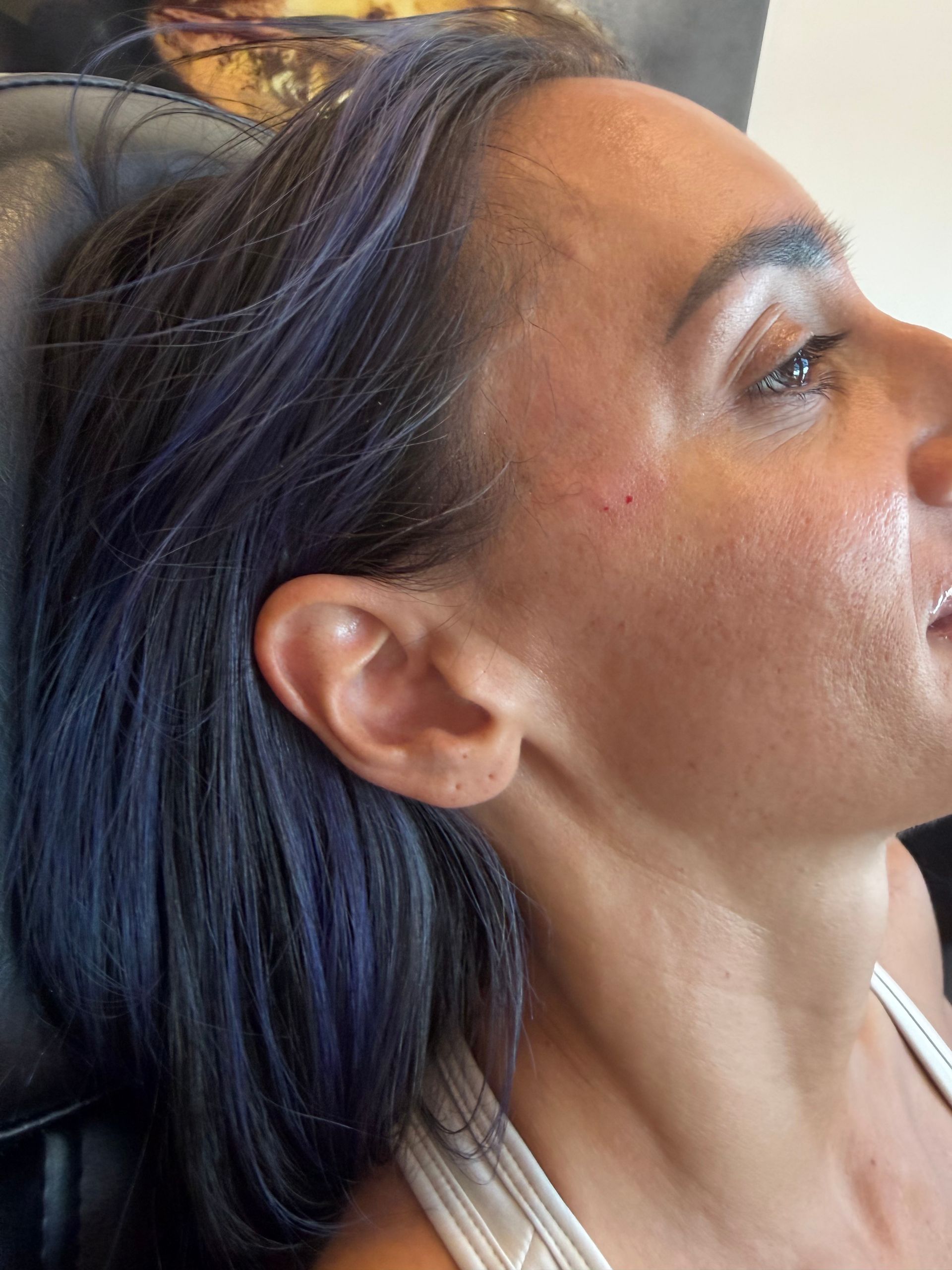 Boston Beautox patient after Sculptra treatment