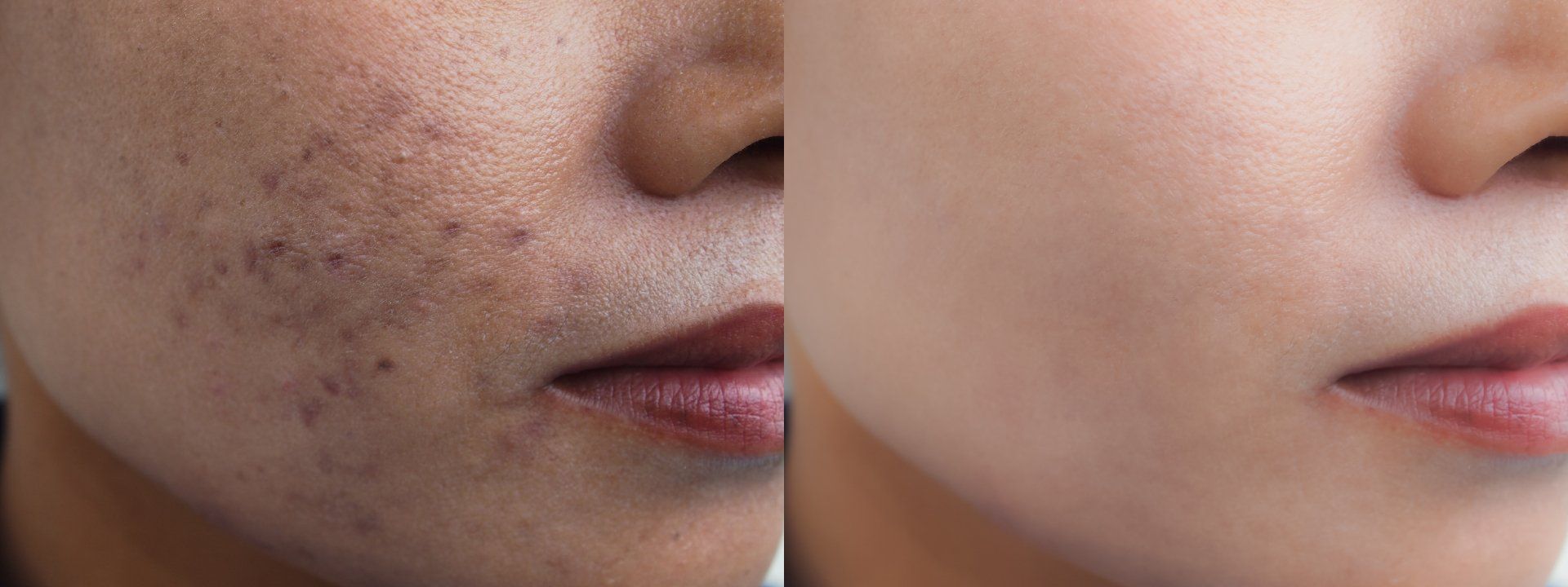 A before and after photo of a woman 's face with acne.