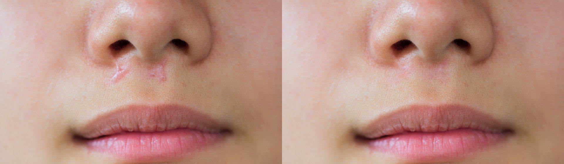 A before and after photo of a woman 's nose and lips.