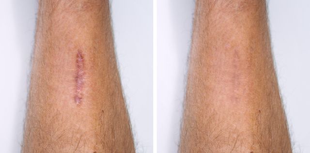A before and after picture of a person 's arm with a scar.