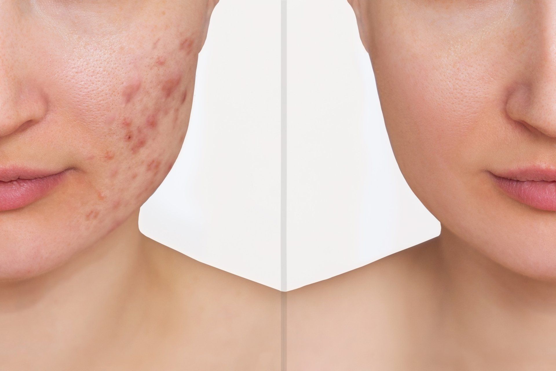 A before and after photo of a woman 's face with acne.