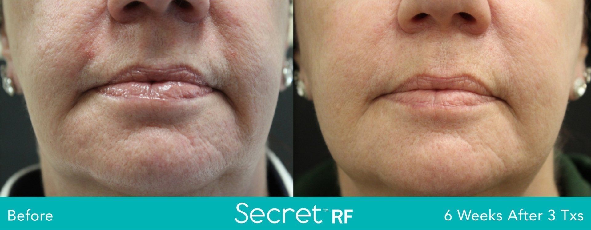 A before and after photo of a woman 's face