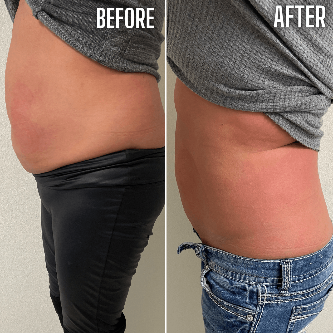 A before and after picture of a woman 's stomach