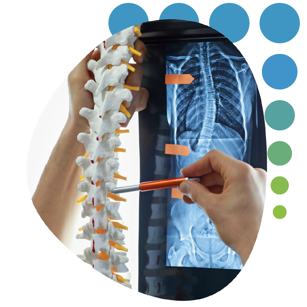 Scoliosis - Specialist with model of spine watching image of chest at x-ray film viewer,. Diagnosis,treatment planning.