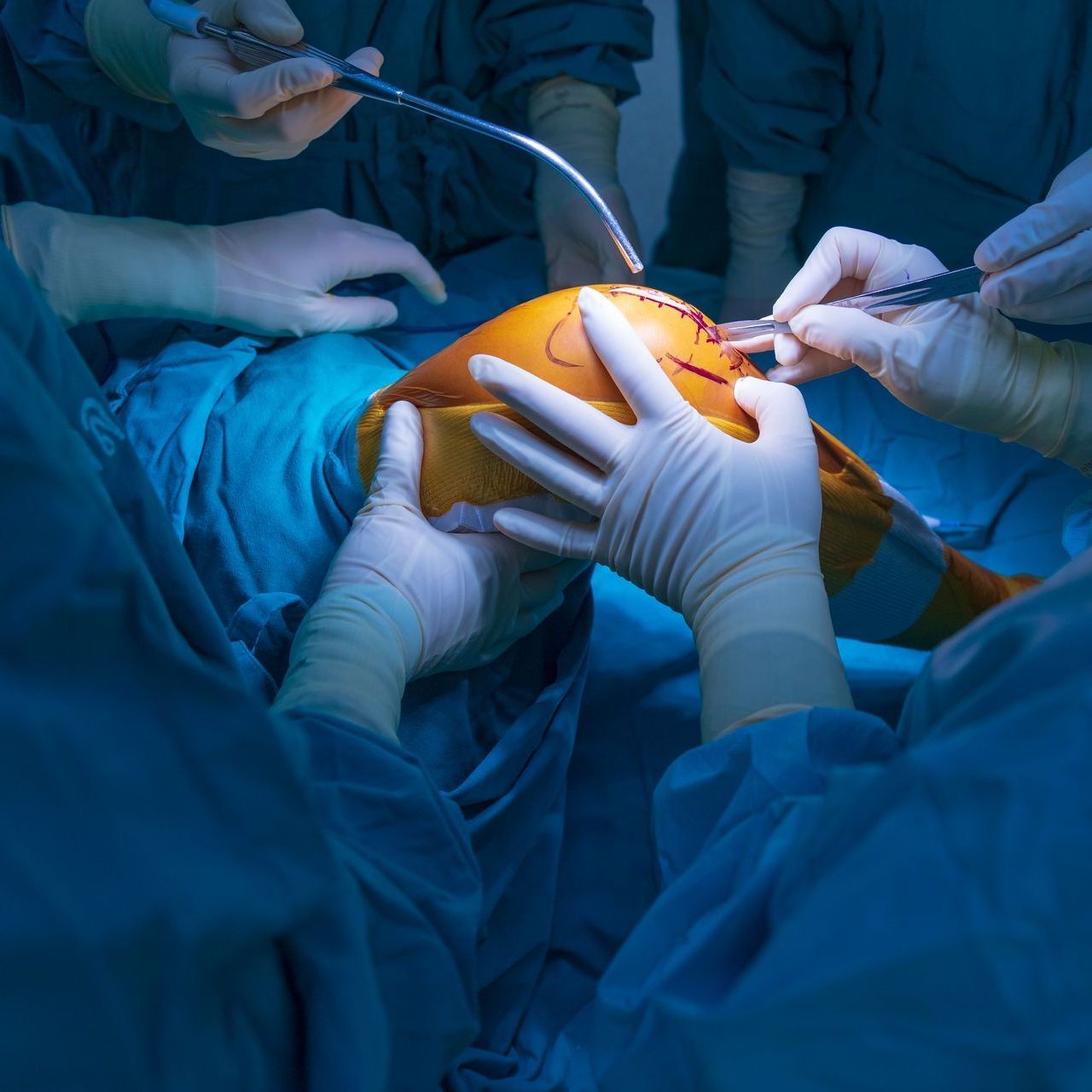 Team of doctor working at operating room in hospital.