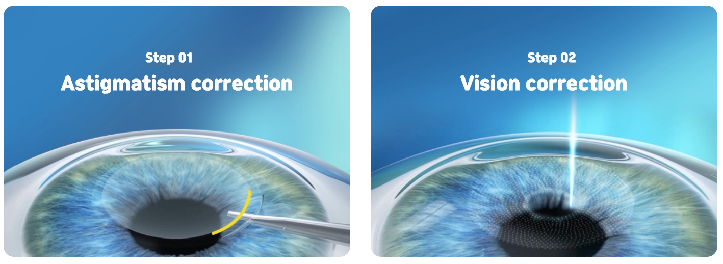 Golden Smile that can correct high astigmatism