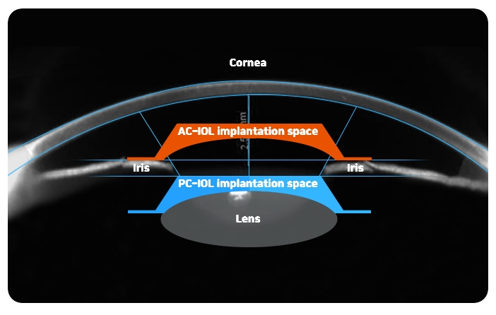 A detailed examination minimizes the size error of the ocular space for IOL insertion
